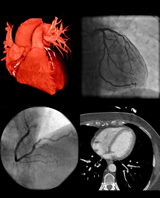 Optical Coherence Tomography Catheter