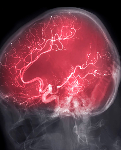 Neurovascular